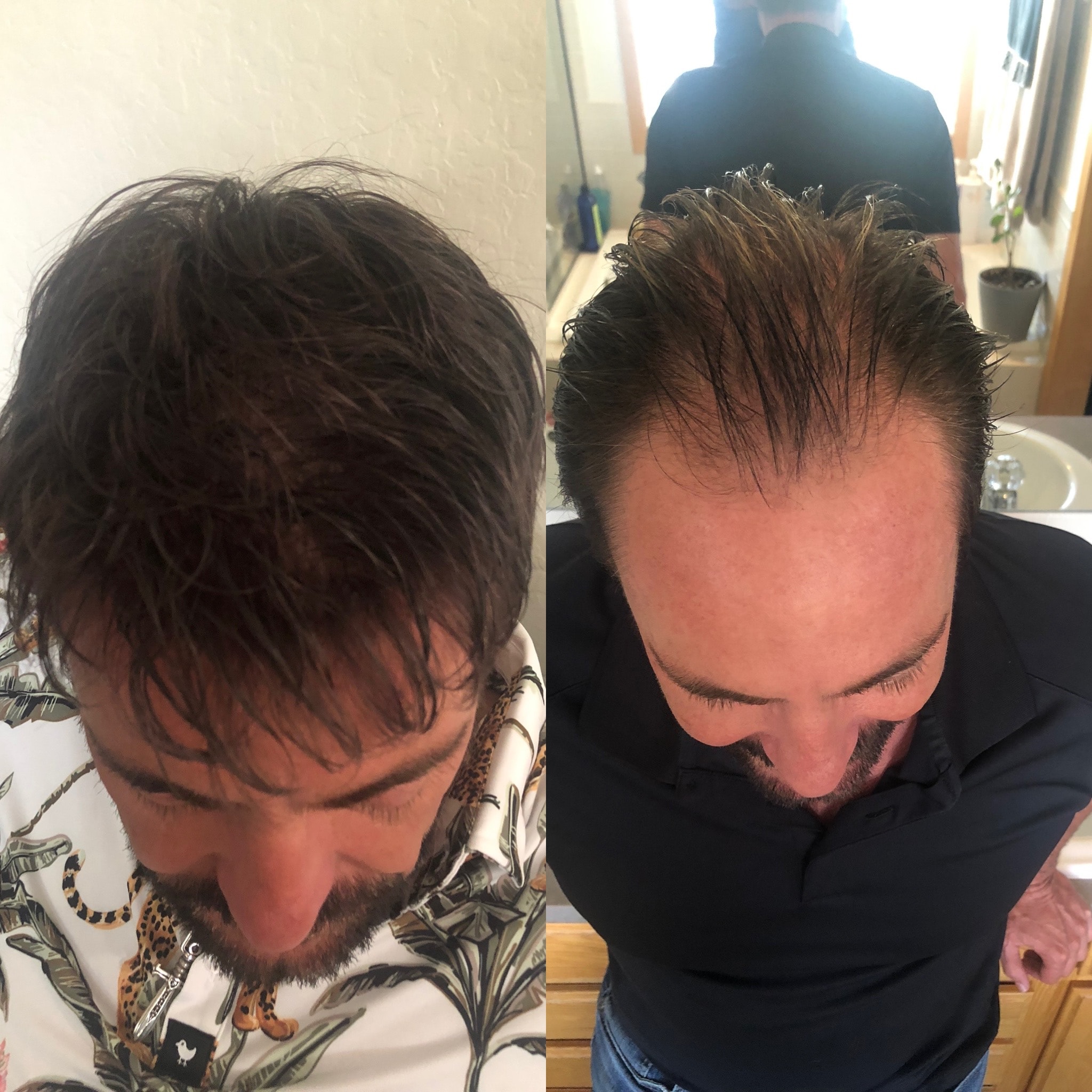 Hair restoration treatment